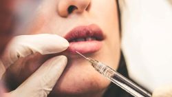 Sculptra Supplier Tips: The Smart Way to Correct Skin Depressions